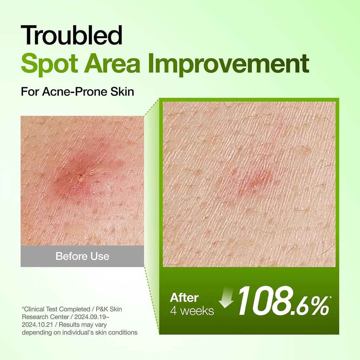 ANUA Azelaic Acid 10 Hyaluron Redness Soothing Serum before and after spot area comparison