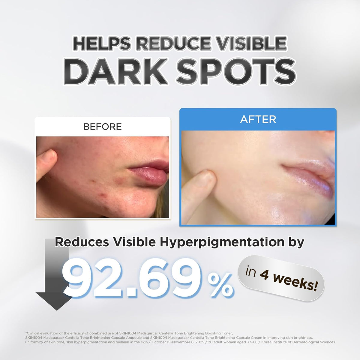 Before-and-after cheek photos reporting 92.69% less visible hyperpigmentation in four weeks in a combined toner, ampoule and cream study of 20 women.