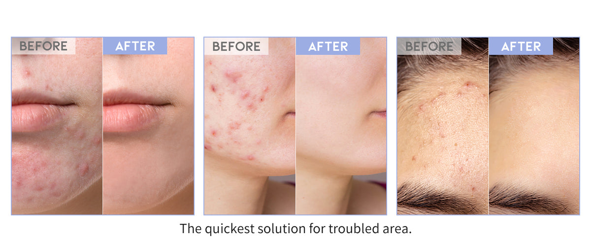 #OOTD Star Spot Pimple Patch, 80 Dots product information panel 02