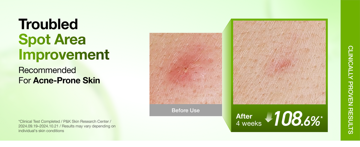 ANUA Azelaic Acid 10 Hyaluron Redness Soothing Serum spot area before and after comparison