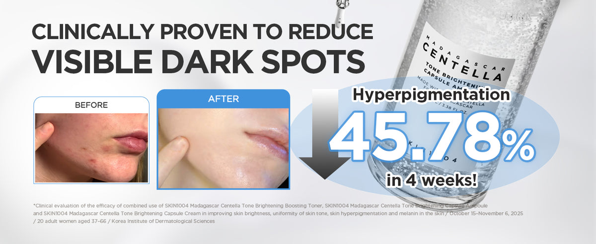 Before-and-after cheek photos reporting a 45.78% hyperpigmentation change in four weeks in a combined toner, ampoule and cream study.