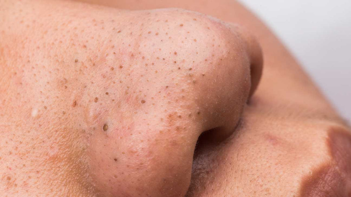 Close-up of dark plugs in open pores on a nose.