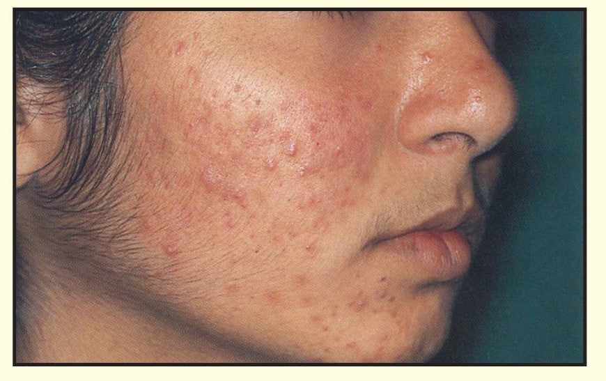 Raised inflamed cheek bumps alongside flat post-acne marks.