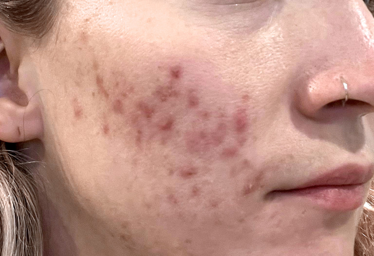 Close-up of pink and red cheek marks alongside other blemishes.