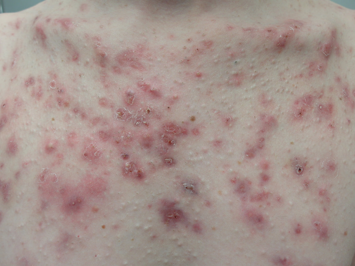 White-centered pustules among inflamed bumps on the chest.