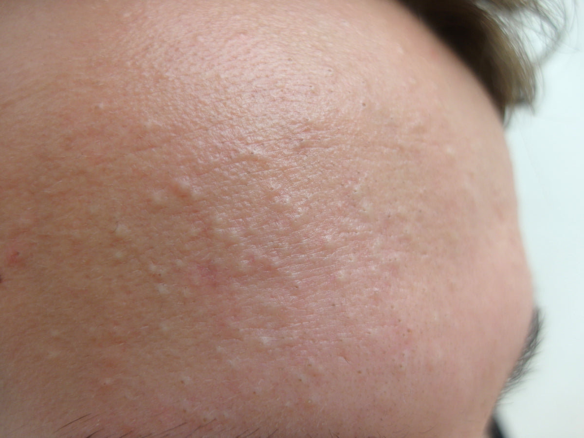 Forehead with small white or skin-colored closed bumps.